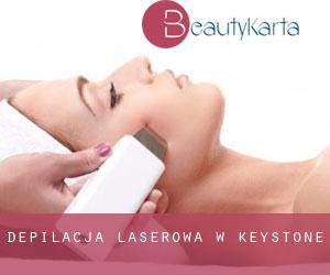 Depilacja laserowa w Keystone